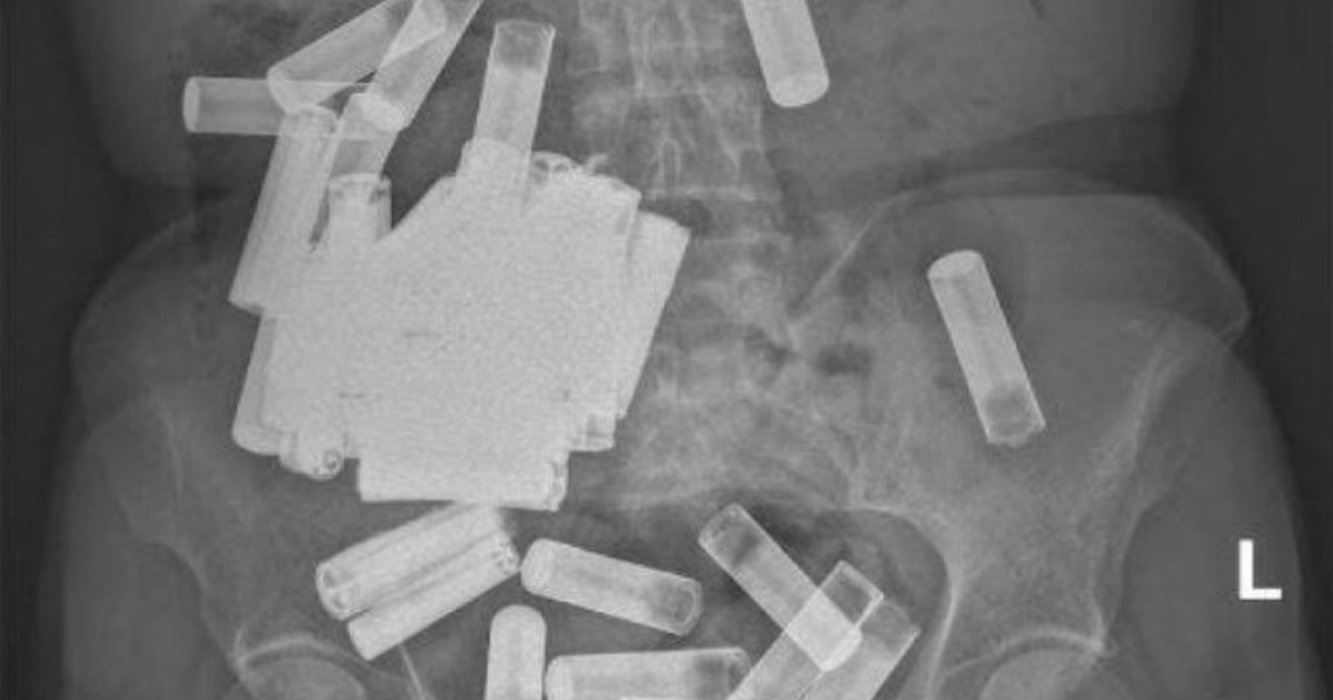 una-mujer-sentia-dolores-en-el-estomago-y-le-extrajeron-55-pilas-aa-y-aaa