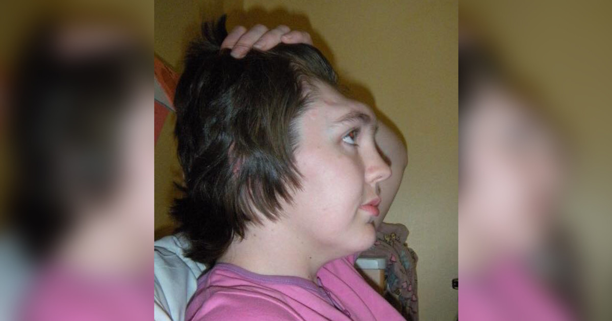 «vivi-dos-anos-sin-frente»:-la-cruda-historia-de-una-mujer-que,-por-una-simple-mala-costumbre,-perdio-esa-parte-de-su-cara