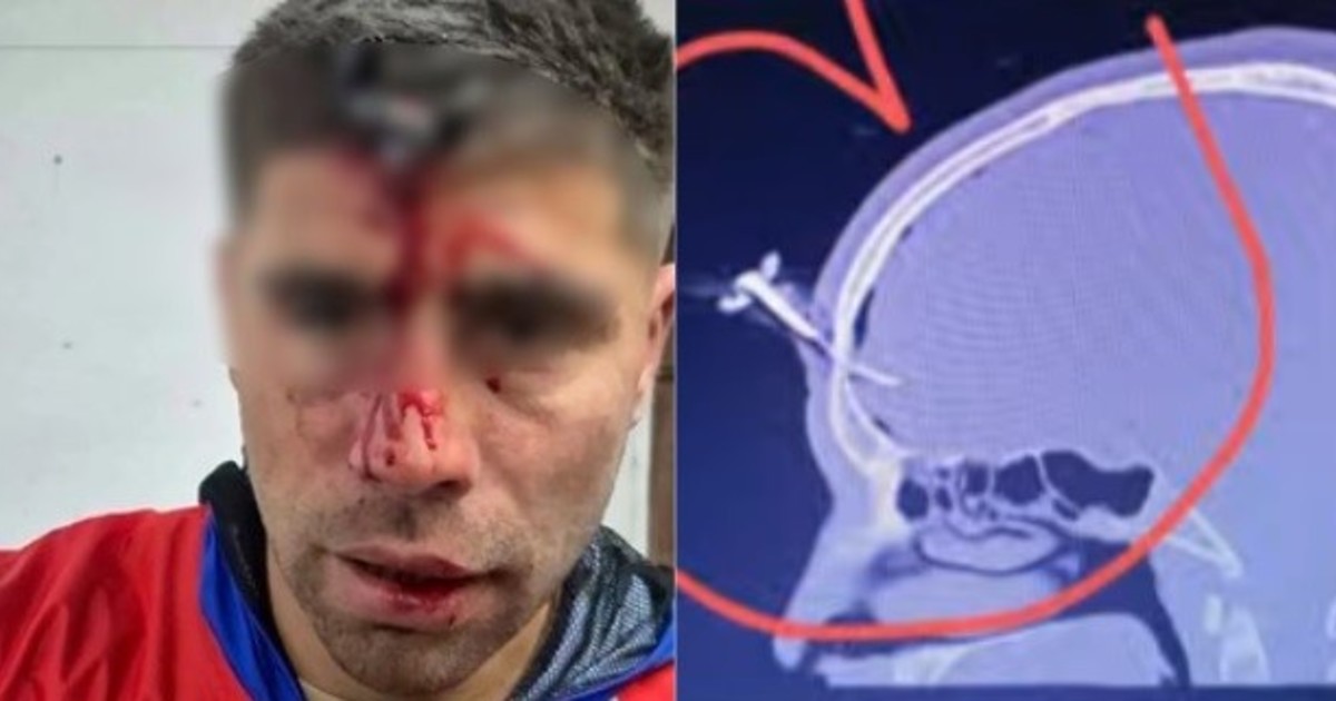 le-clavaron-una-llave-en-la-cabeza-a-un-jugador-del-ascenso-durante-una-salvaje-pelea-en-un-torneo-de-futbol-femenino