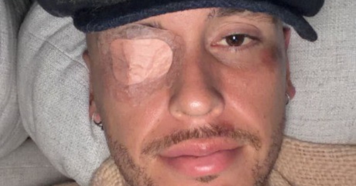 el-delicado-momento-de-salud-de-lucas-ocampos:-tras-fracturarse,-sufrio-una-paralisis-facial-y-se-pierde-la-pretemporada-en-mexico